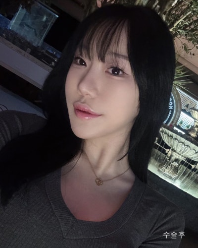 돌출된 광대 윤곽3종 전후와 회복기간 사진 5
