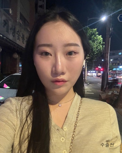 돌출된 광대 윤곽3종 전후와 회복기간 사진 2