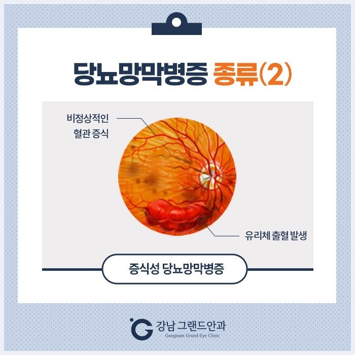 강남 당뇨망막병증 증상 레이저 수술 주사 치료 안과 사진 5