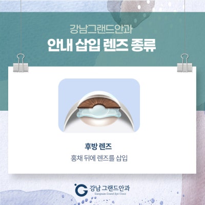 ICL 렌즈삽입술 수술 강남 병원 사진 4