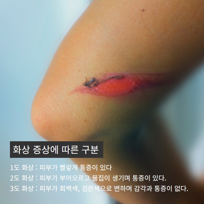 겨울방학 아이들 화상주의, 응급처지 및 예방하기 아이들외상치료는 서래성형외과 사진 3