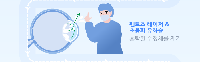 多焦点老花眼白内障手术是什么?/江南Smile眼科,江南眼科推荐 사진 5