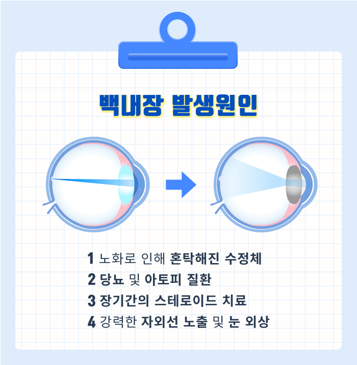 [ต้อกระจก] สาเหตุของต้อกระจกที่ทำให้ตามัวคืออะไร?! 사진 3