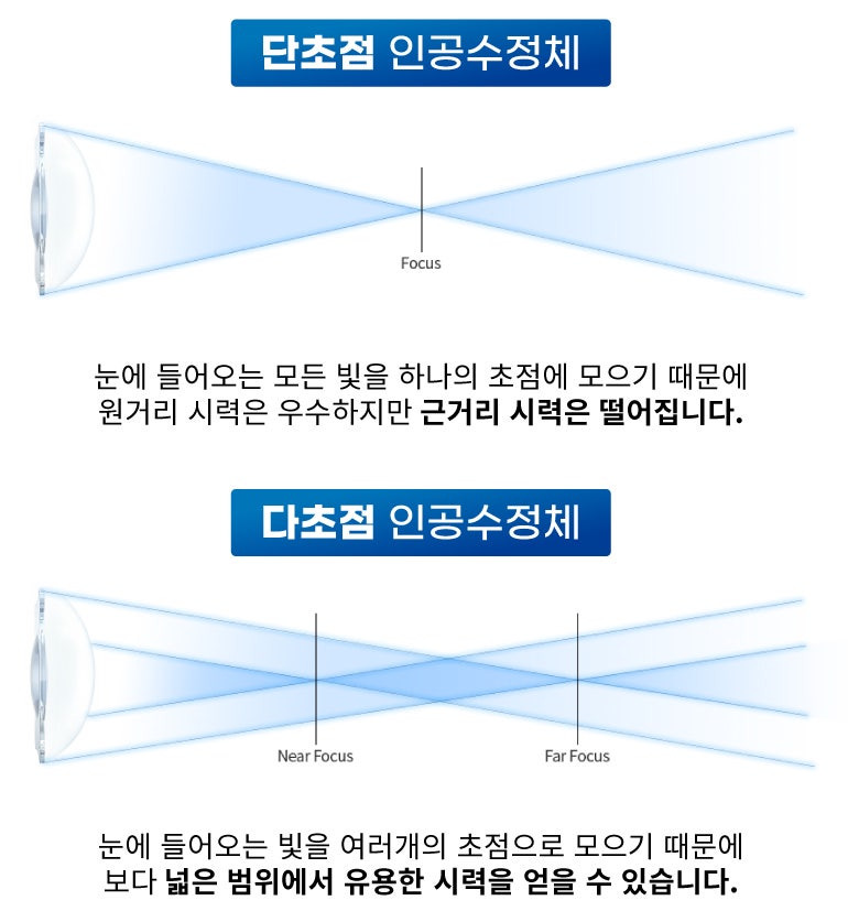 Definisi dan Metode Operasi Katarak Presbiopia di Smile Eye Clinic Gangnam 사진 13