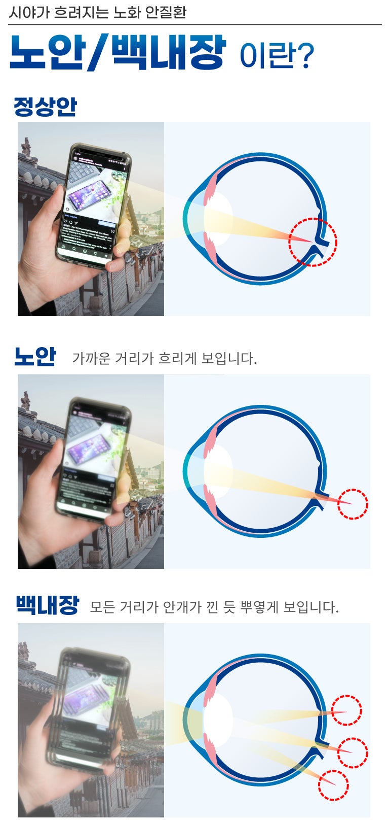 Definisi dan Metode Operasi Katarak Presbiopia di Smile Eye Clinic Gangnam