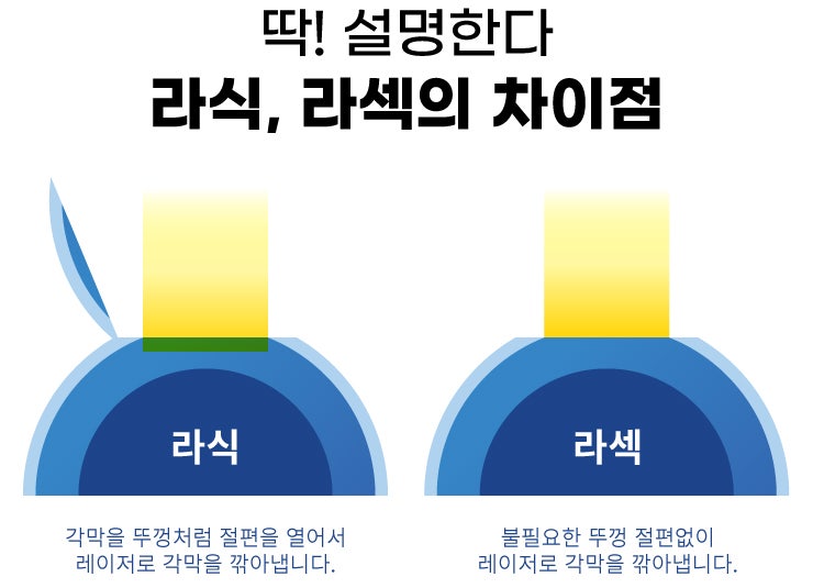 การผ่าตัดแก้ไขสายตาของนักกีฬา แบบไหนที่เหมาะสม?