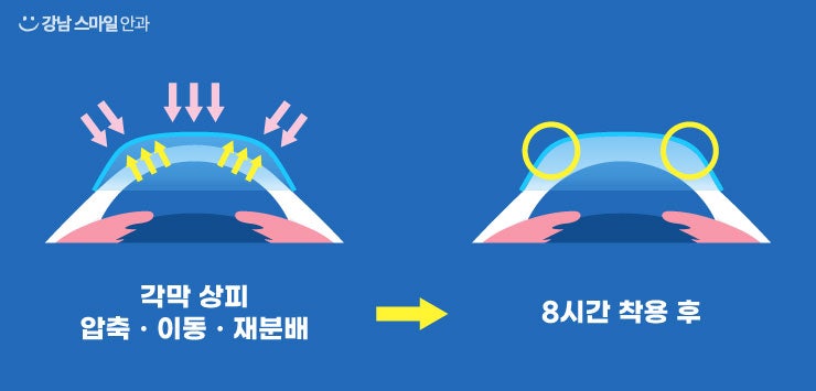 【Gangnam Smile Eye Clinic】สามารถแก้ไขสายตาในผู้เยาว์ได้หรือไม่? 사진 5