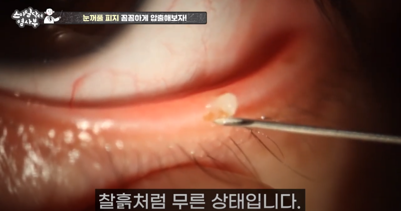 더 강력하게 돌아온 눈꺼풀 피지짜기 3! / ★★고름과 눈꺼풀피지를 한번에 뿌리까지 쫘아악★★ 사진 18