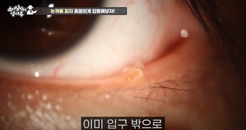더 강력하게 돌아온 눈꺼풀 피지짜기 3! / ★★고름과 눈꺼풀피지를 한번에 뿌리까지 쫘아악★★ 사진 11