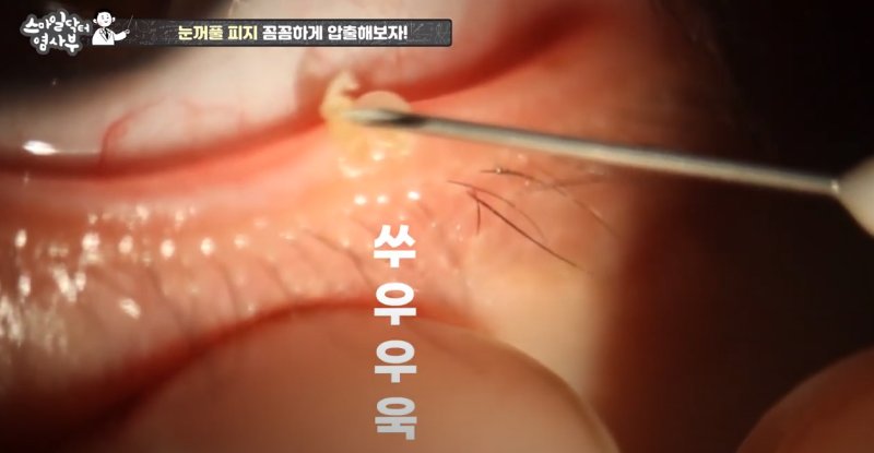 더 강력하게 돌아온 눈꺼풀 피지짜기 3! / ★★고름과 눈꺼풀피지를 한번에 뿌리까지 쫘아악★★ 사진 19
