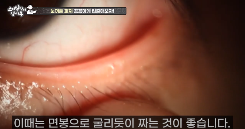 더 강력하게 돌아온 눈꺼풀 피지짜기 3! / ★★고름과 눈꺼풀피지를 한번에 뿌리까지 쫘아악★★ 사진 24