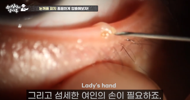 더 강력하게 돌아온 눈꺼풀 피지짜기 3! / ★★고름과 눈꺼풀피지를 한번에 뿌리까지 쫘아악★★ 사진 7