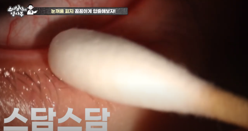 더 강력하게 돌아온 눈꺼풀 피지짜기 3! / ★★고름과 눈꺼풀피지를 한번에 뿌리까지 쫘아악★★ 사진 25