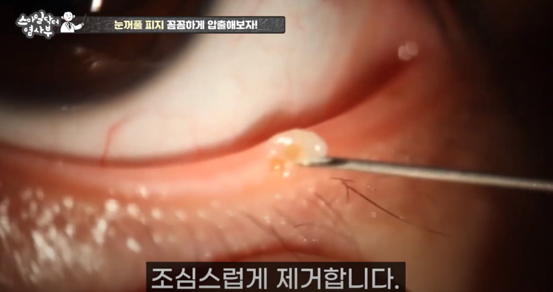 더 강력하게 돌아온 눈꺼풀 피지짜기 3! / ★★고름과 눈꺼풀피지를 한번에 뿌리까지 쫘아악★★ 사진 16