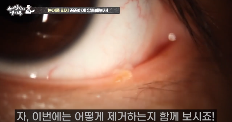 더 강력하게 돌아온 눈꺼풀 피지짜기 3! / ★★고름과 눈꺼풀피지를 한번에 뿌리까지 쫘아악★★ 사진 10