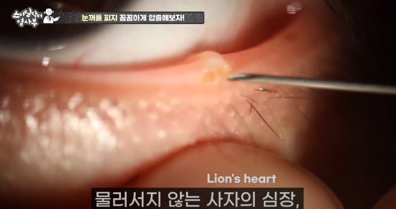더 강력하게 돌아온 눈꺼풀 피지짜기 3! / ★★고름과 눈꺼풀피지를 한번에 뿌리까지 쫘아악★★ 사진 6