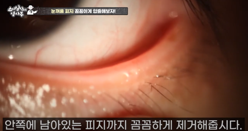 더 강력하게 돌아온 눈꺼풀 피지짜기 3! / ★★고름과 눈꺼풀피지를 한번에 뿌리까지 쫘아악★★ 사진 23