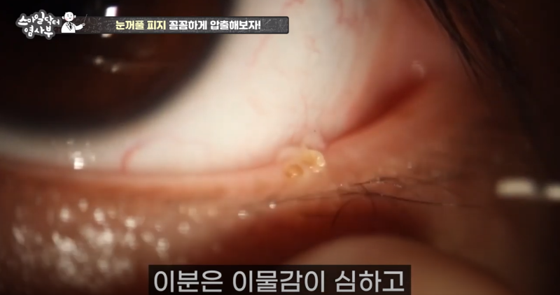 더 강력하게 돌아온 눈꺼풀 피지짜기 3! / ★★고름과 눈꺼풀피지를 한번에 뿌리까지 쫘아악★★ 사진 13