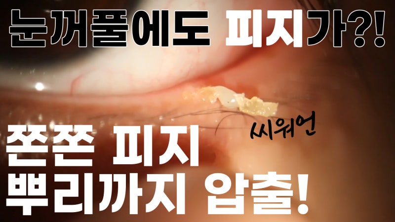 더 강력하게 돌아온 눈꺼풀 피지짜기 3! / ★★고름과 눈꺼풀피지를 한번에 뿌리까지 쫘아악★★
