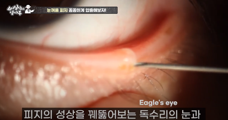 더 강력하게 돌아온 눈꺼풀 피지짜기 3! / ★★고름과 눈꺼풀피지를 한번에 뿌리까지 쫘아악★★ 사진 5