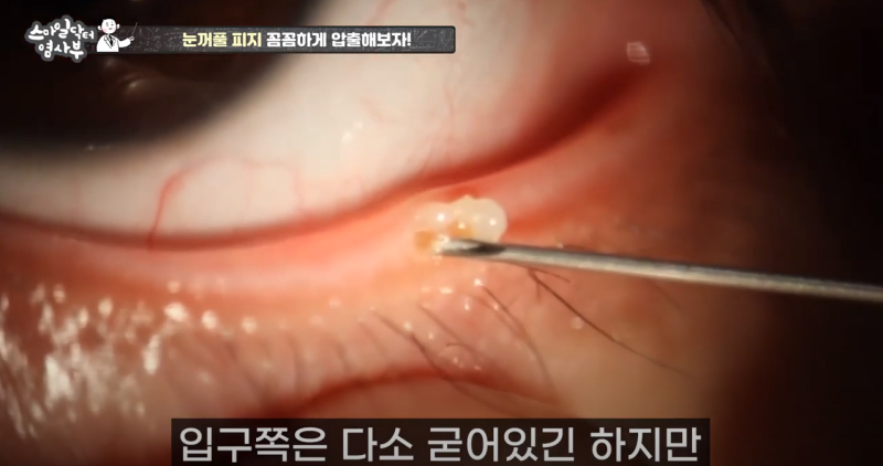 더 강력하게 돌아온 눈꺼풀 피지짜기 3! / ★★고름과 눈꺼풀피지를 한번에 뿌리까지 쫘아악★★ 사진 17