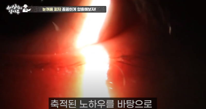 더 강력하게 돌아온 눈꺼풀 피지짜기 3! / ★★고름과 눈꺼풀피지를 한번에 뿌리까지 쫘아악★★ 사진 27
