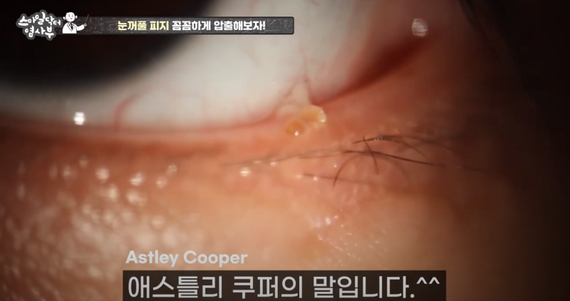 더 강력하게 돌아온 눈꺼풀 피지짜기 3! / ★★고름과 눈꺼풀피지를 한번에 뿌리까지 쫘아악★★ 사진 9