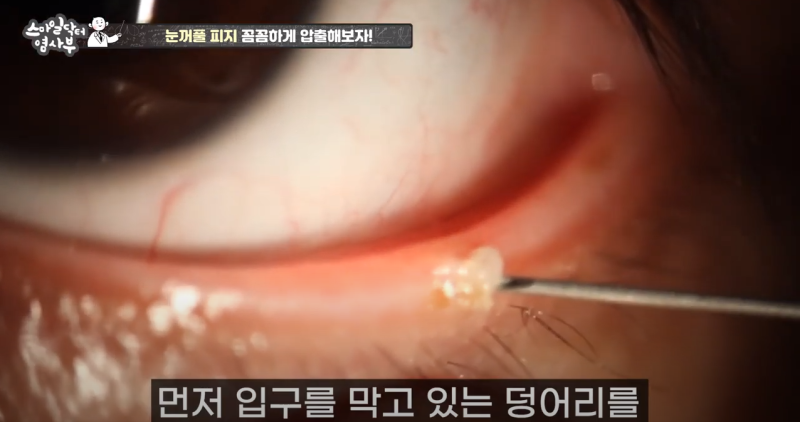 더 강력하게 돌아온 눈꺼풀 피지짜기 3! / ★★고름과 눈꺼풀피지를 한번에 뿌리까지 쫘아악★★ 사진 15