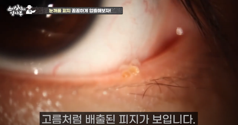 더 강력하게 돌아온 눈꺼풀 피지짜기 3! / ★★고름과 눈꺼풀피지를 한번에 뿌리까지 쫘아악★★ 사진 12
