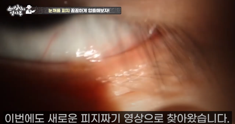 더 강력하게 돌아온 눈꺼풀 피지짜기 3! / ★★고름과 눈꺼풀피지를 한번에 뿌리까지 쫘아악★★ 사진 3