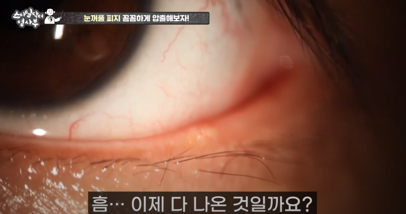 더 강력하게 돌아온 눈꺼풀 피지짜기 3! / ★★고름과 눈꺼풀피지를 한번에 뿌리까지 쫘아악★★ 사진 21