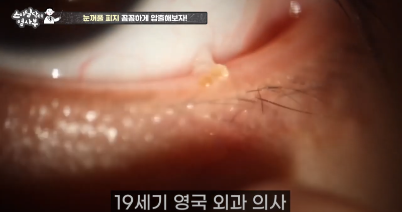 더 강력하게 돌아온 눈꺼풀 피지짜기 3! / ★★고름과 눈꺼풀피지를 한번에 뿌리까지 쫘아악★★ 사진 8