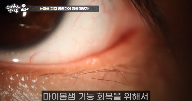 더 강력하게 돌아온 눈꺼풀 피지짜기 3! / ★★고름과 눈꺼풀피지를 한번에 뿌리까지 쫘아악★★ 사진 22
