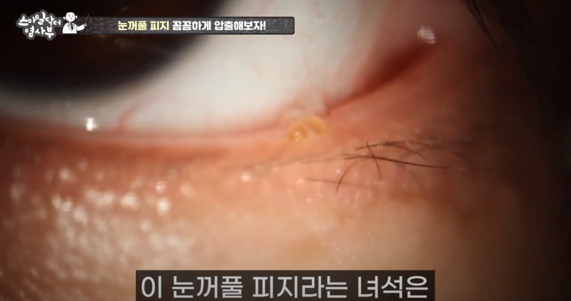 더 강력하게 돌아온 눈꺼풀 피지짜기 3! / ★★고름과 눈꺼풀피지를 한번에 뿌리까지 쫘아악★★ 사진 4