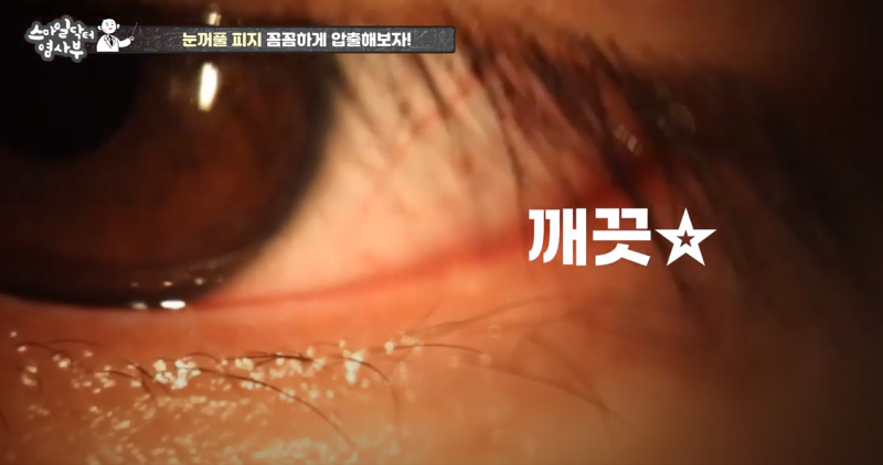 더 강력하게 돌아온 눈꺼풀 피지짜기 3! / ★★고름과 눈꺼풀피지를 한번에 뿌리까지 쫘아악★★ 사진 26
