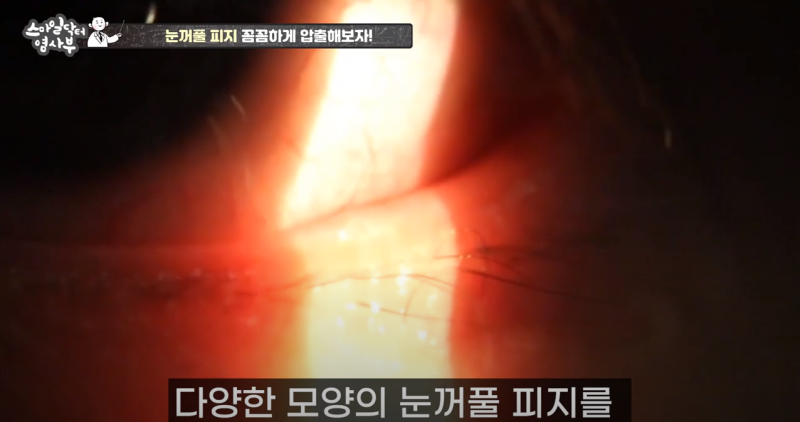 더 강력하게 돌아온 눈꺼풀 피지짜기 3! / ★★고름과 눈꺼풀피지를 한번에 뿌리까지 쫘아악★★ 사진 28