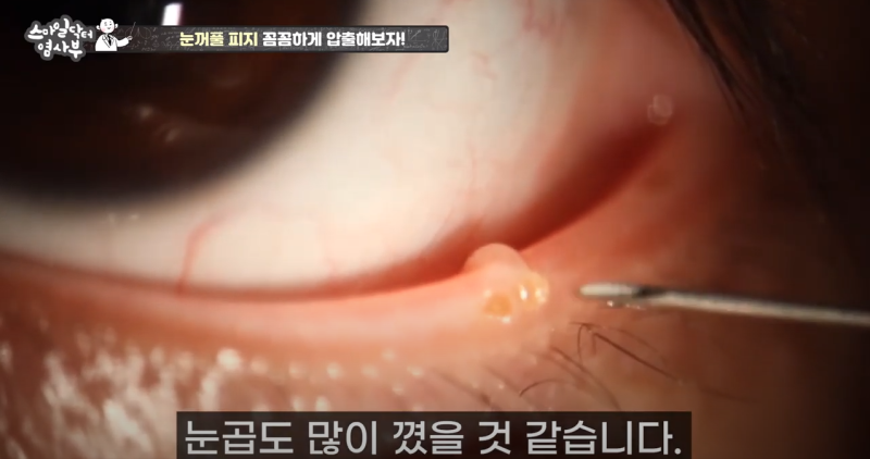 더 강력하게 돌아온 눈꺼풀 피지짜기 3! / ★★고름과 눈꺼풀피지를 한번에 뿌리까지 쫘아악★★ 사진 14