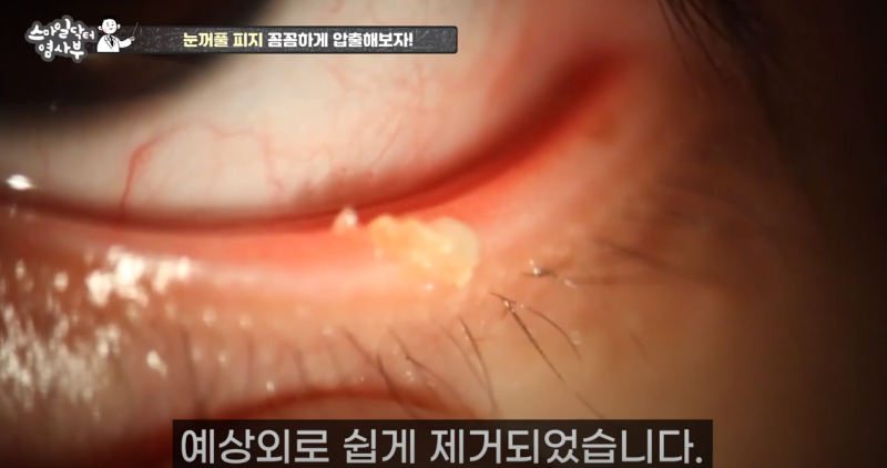 더 강력하게 돌아온 눈꺼풀 피지짜기 3! / ★★고름과 눈꺼풀피지를 한번에 뿌리까지 쫘아악★★ 사진 20