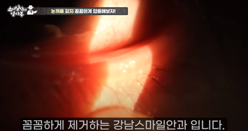 더 강력하게 돌아온 눈꺼풀 피지짜기 3! / ★★고름과 눈꺼풀피지를 한번에 뿌리까지 쫘아악★★ 사진 29