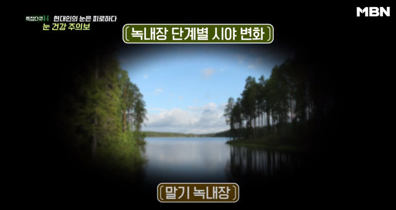 [MBN เตือนภัยสุขภาพตา] ผู้อำนวยการอี ชาง-มก จากโรงพยาบาลจักษุคังนัมสไมล์ ออกอากาศ 사진 8