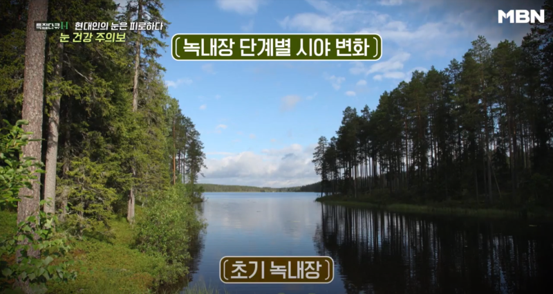 [MBN เตือนภัยสุขภาพตา] ผู้อำนวยการอี ชาง-มก จากโรงพยาบาลจักษุคังนัมสไมล์ ออกอากาศ 사진 6