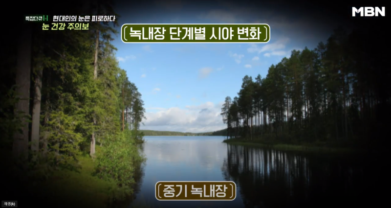 [MBN เตือนภัยสุขภาพตา] ผู้อำนวยการอี ชาง-มก จากโรงพยาบาลจักษุคังนัมสไมล์ ออกอากาศ 사진 7