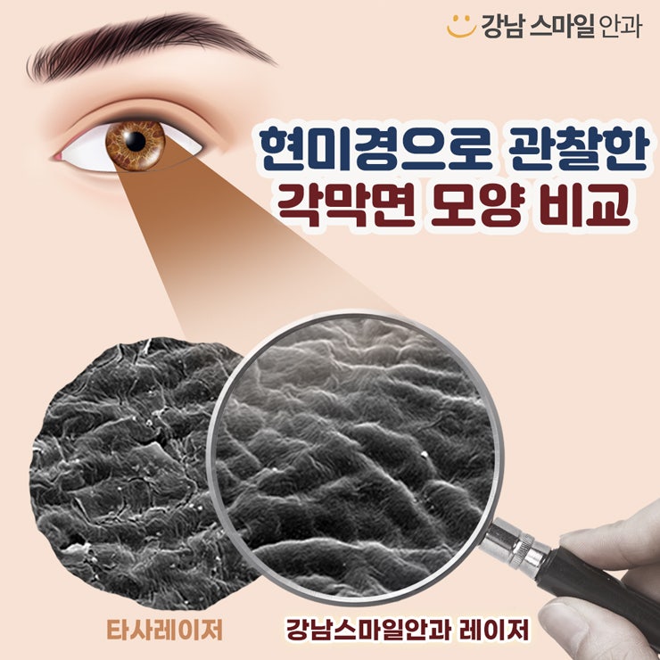 กังวลเรื่องความหนาของกระจกตาในการทำเลสิกใช่ไหม? 사진 4