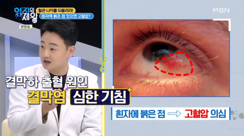 [MBN ออมจีเอเจวัง ตอนที่ 421] ผู้อำนวยการย็อม ดง-จู จากโรงพยาบาลจักษุคังนัมสไมล์อาย ออกอากาศในสตูดิโอ 사진 9