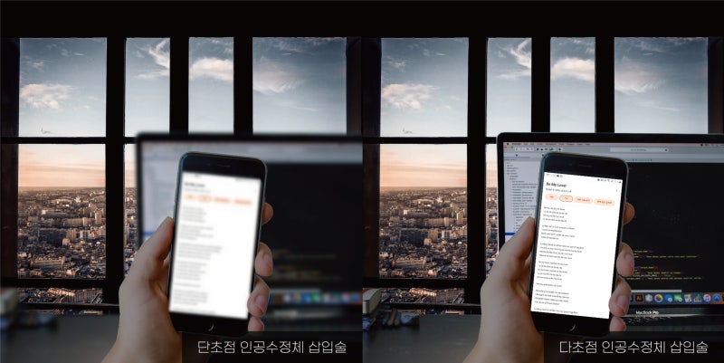 [مستشفى جانجنام سمايل للعيون] إعتام عدسة العين الذي لم تكن تعرفه، عدسة Synergy Lens من الجيل التالي لعام 2021