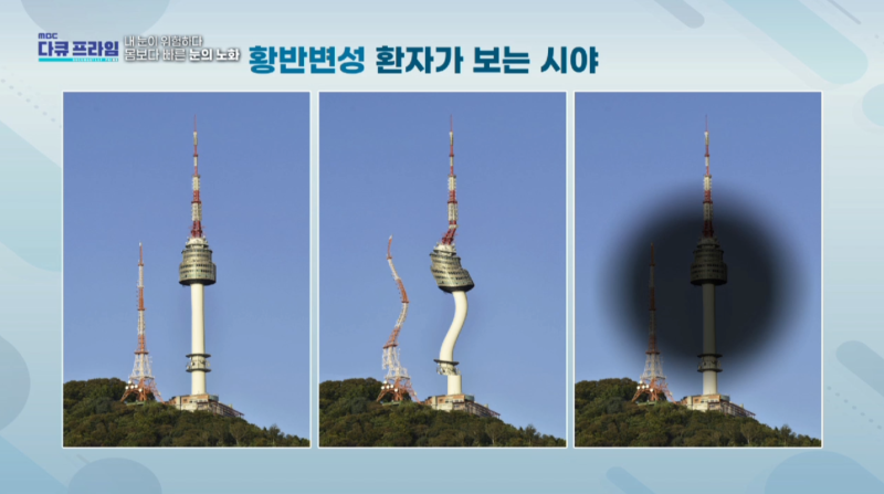 [MBC Docuprime Episode 401] Direktur Yoon Hyo-seong dari Gangnam Smile Eye Clinic Tampil di Siaran 사진 18