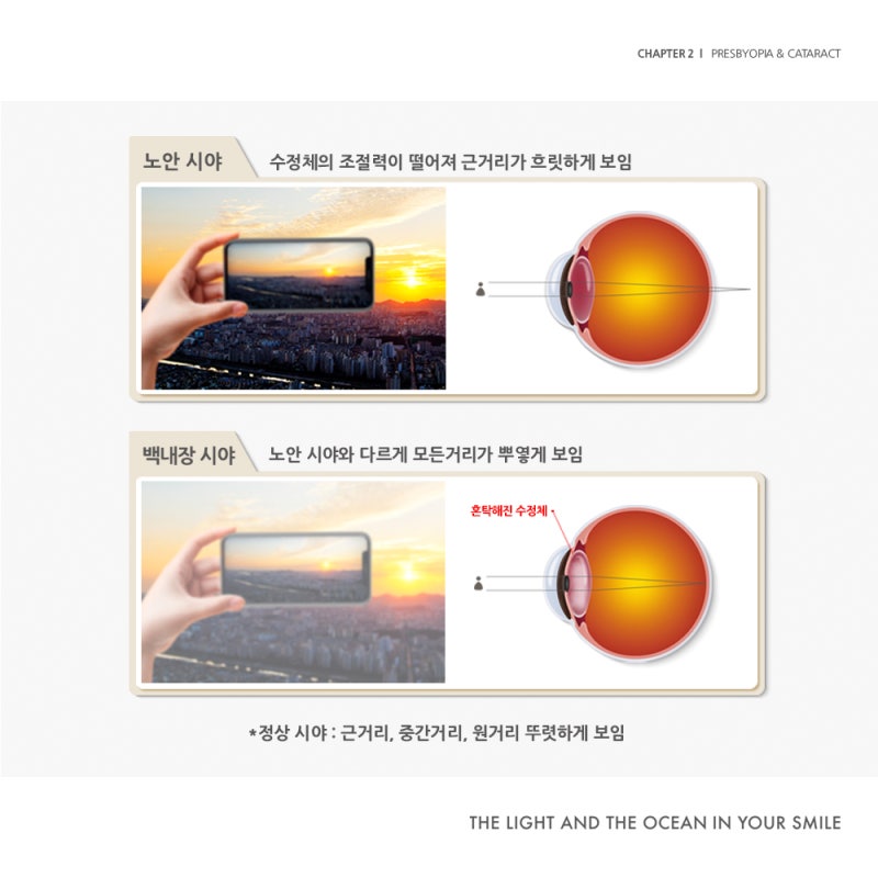 江南スマイル眼科の『助けてアイズ:老眼&白内障編』 사진 5