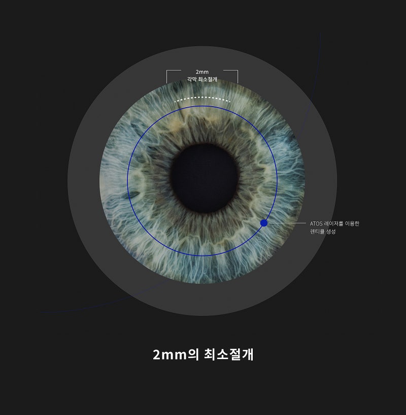 Gangnam Smile Eye Clinic Memperkenalkan Peralatan Bedah NEW SMILE LASIK Schwind ATOS! 사진 3