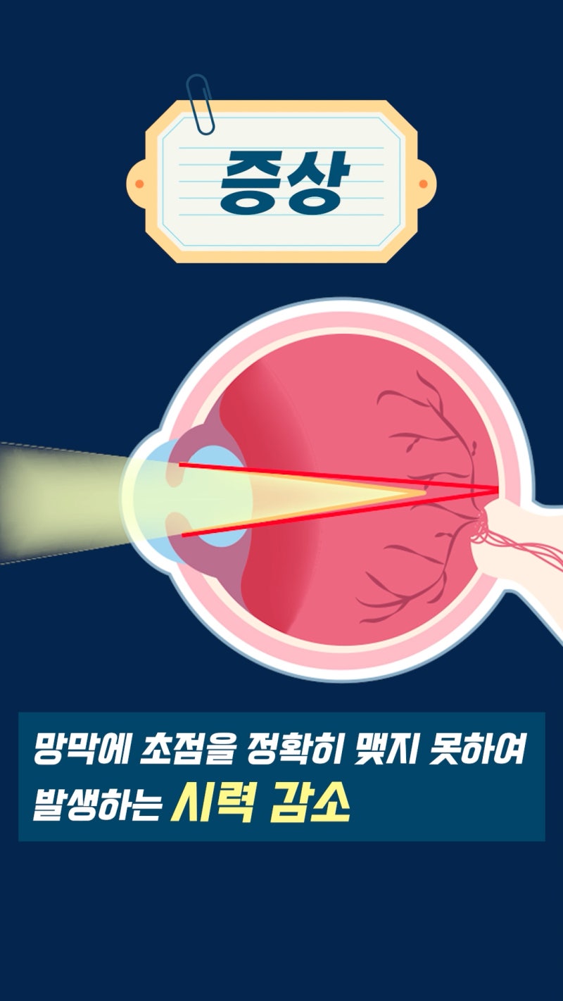 ما هو قصر النظر؟ معلومات طب العيون من عيادة جانجنام سمايل لطب العيون! 사진 8