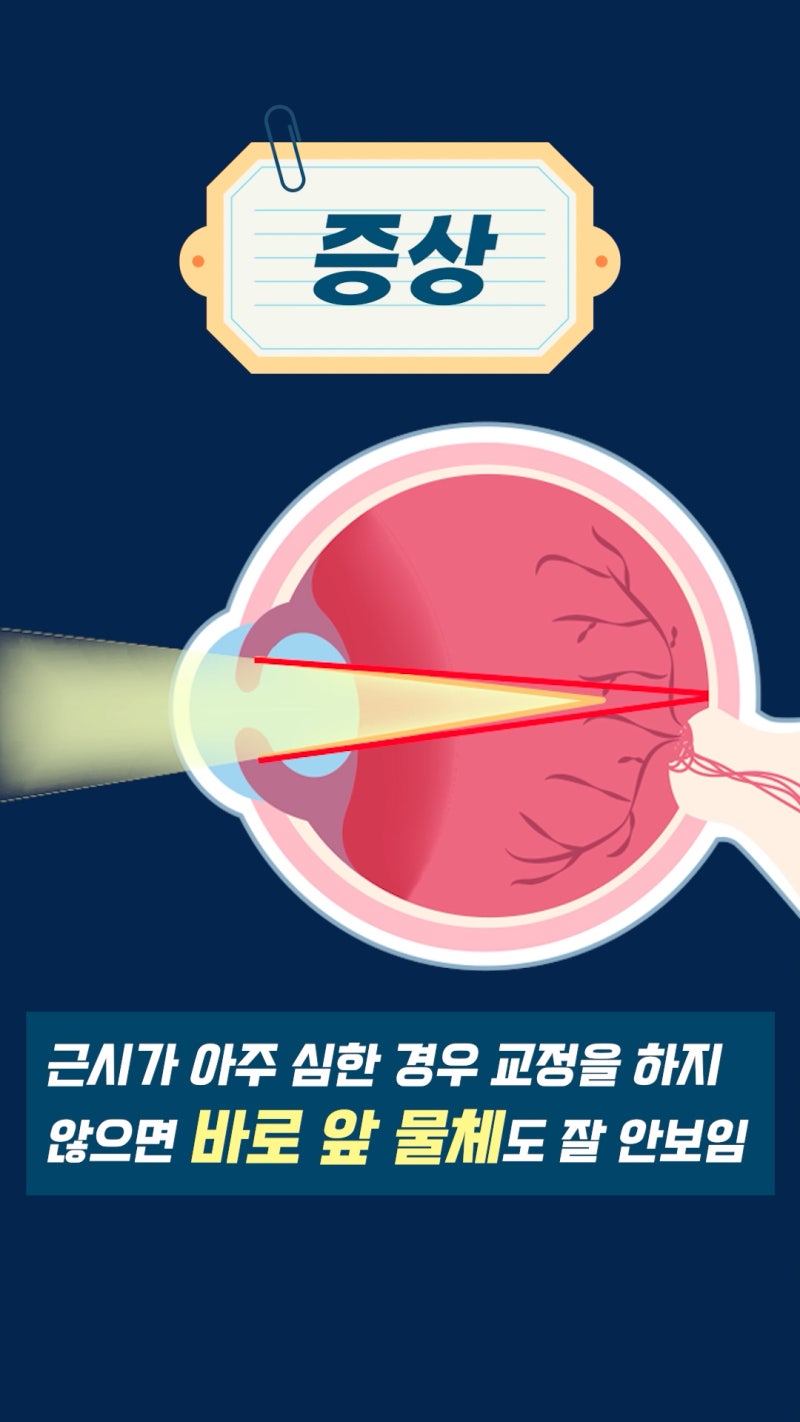 ما هو قصر النظر؟ معلومات طب العيون من عيادة جانجنام سمايل لطب العيون! 사진 9